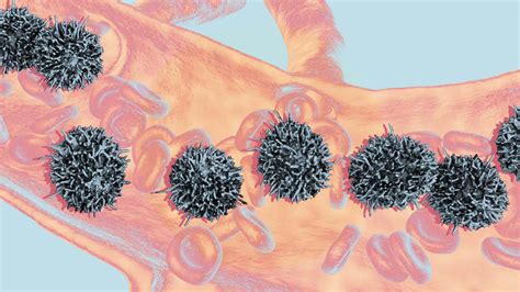 What Is Hairy Cell Leukemia?