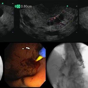 EUS-guided choledochoduodenostomy. It is demonstrated the step-by-step ...