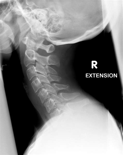 Healthy Cervical Spine Xray