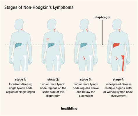 Non-Hodgkin's Lymphoma Stages