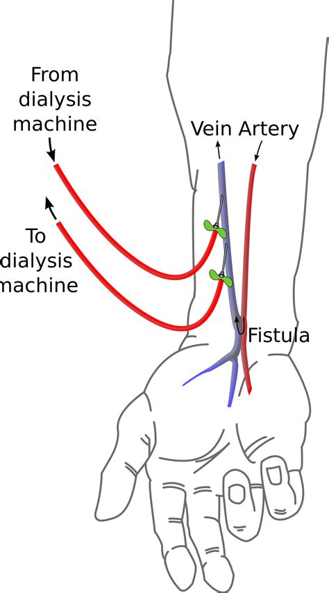 Cimino fistula - Wikipedia