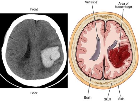 Arteriovenous Malformation - Brain Avm - Causes, Symptoms, Treatment