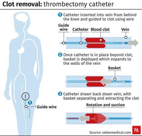 UK patient first to be treated with clot-removing device | BT