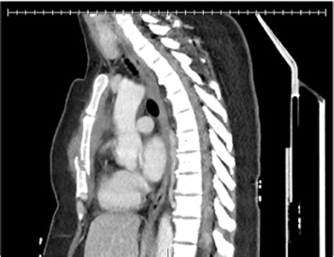 CT chest of sternal fracture. CT imaging demonstrating our patient's ...