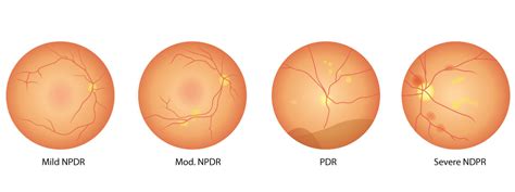 The 4 Stages of Diabetic Retinopathy | Eyeland Vision | Diabetic ...