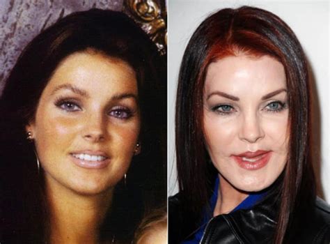 20 Worst Cases Of Celebrity Plastic Surgery Gone Wrong - Page 5 of 5