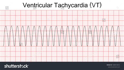 Ventricular Tachycardia Ecg