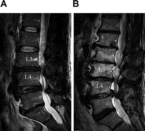 Redundant Nerve Roots of the Cauda Equina, MRI Findings and ...