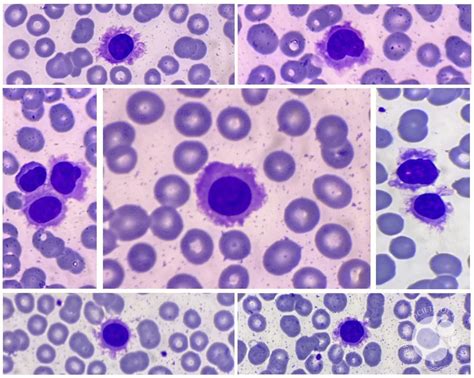 Hairy Cell Leukemia