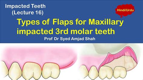 Types Of Flaps In Dental Surgery - Design Talk