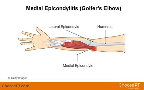 Guide | Physical Therapy Guide to Golfer's Elbow (Medial Epicondylitis ...