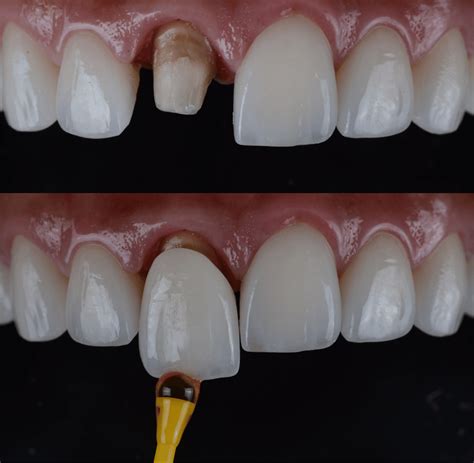 Anterior Crowns: The Ultimate Guide for Dentists | Avant Dental