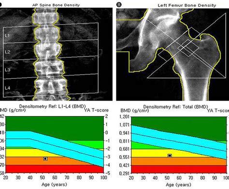 DEXA | Prognosis Advanced Diagnostic Center