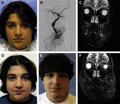 Management of Arteriovenous Malformations | Plastic Surgery Key