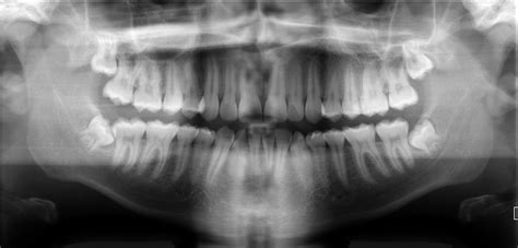 Pros of Digital X-Rays for Dental Work (for Kids and Adults)