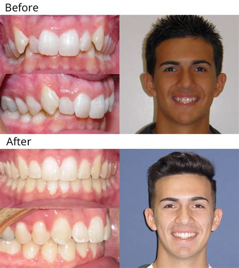 Before and After Gallery - West Temple Orthodontics | Temple TX