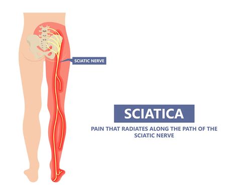 Sciatica and What you need to know | ACC