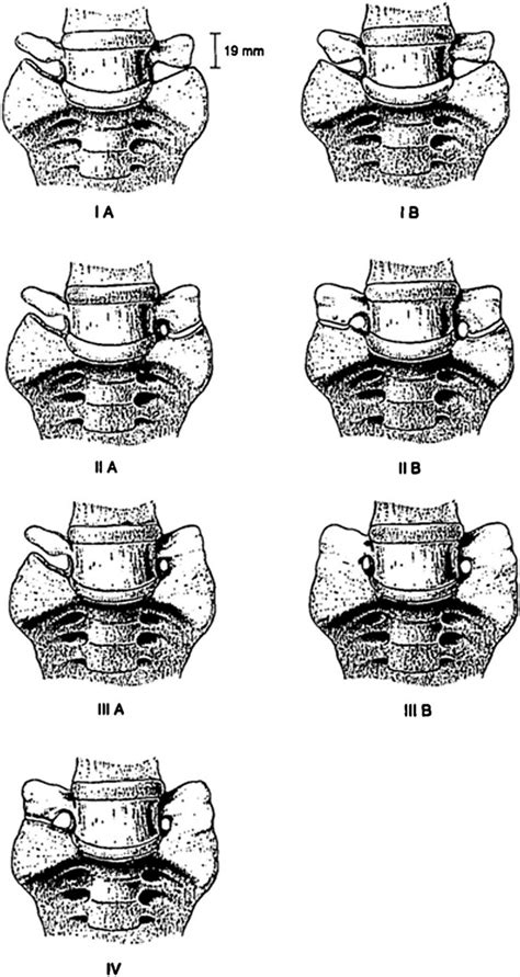 Skull and Spine: Lumbosacral transitional vertebrae