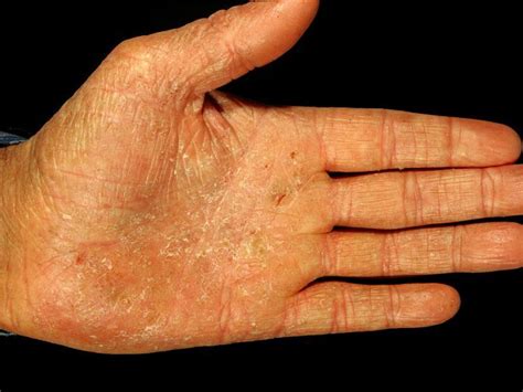 Dyshidrosis of hands and feet: causes, symptoms, treatment. Ointments ...