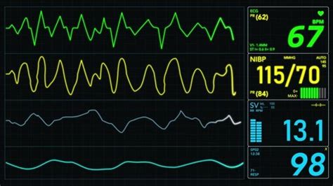 Ecg Hospital Monitor Screen Patient Monitoring Stock Footage Video (100 ...