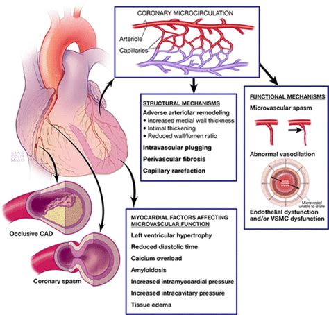 Reappraisal of Ischemic Heart Disease - International Heart Spasms Alliance