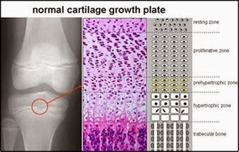 Treating Achondroplasia: Treating achondroplasia: CNP under the spotlight