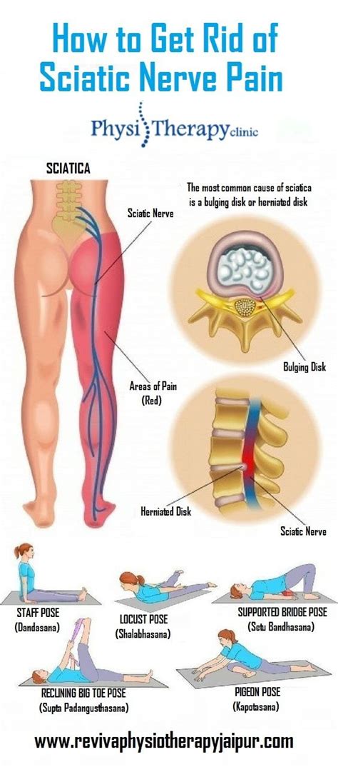 Where Is Sciatic Pain Felt - Cares Healthy