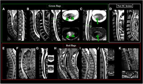 Lesions On Mri T Spine