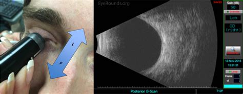 Ocular Ultrasound: A Quick Reference Guide for the On-Call Physician