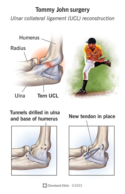 Tommy John Surgery: Details & Recovery Time