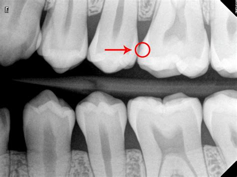 Tooth Abscess Stages: Pictures and Treatment Options - Web DMD