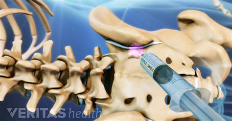 Sacroiliac Joint Injection Side Effects and Risks