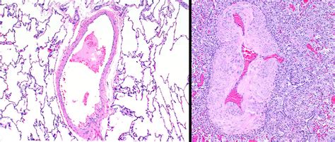 Pulmonary Arterial Hypertension Histology - Rare Disease Advisor