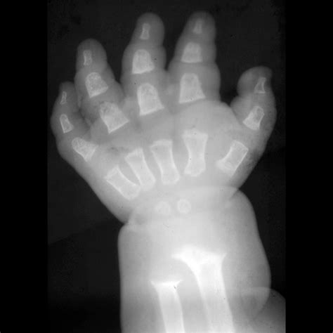 Preschooler with short stature | Pediatric Radiology Case | Pediatric ...