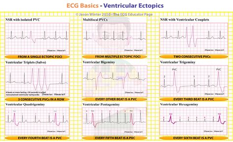 ECG Educator Blog : Ventricular Ectopics