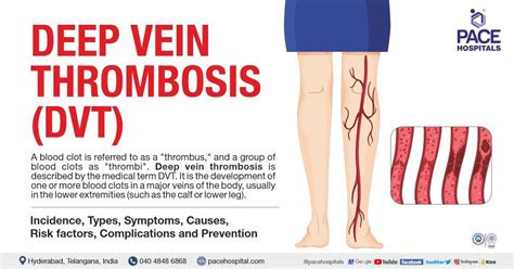 Deep Vein Thrombosis, DVT - Symptoms, Causes and Complications