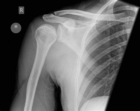 Shoulder Dislocation X Ray