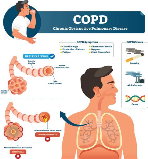 Chronic Obstructive Pulmonary Disease | COPD Treatment London