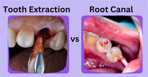 Comparing Tooth Extraction vs Root Canal: What's the Difference? | Sri ...