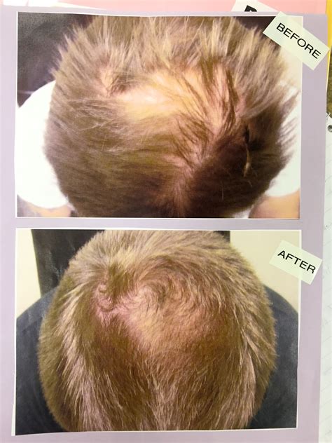 Laser Hair Growth Treatment Call for Free Consultation Las Vegas Reno