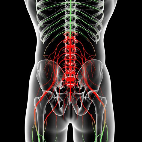 Why Disc Herniations Cause Sciatica