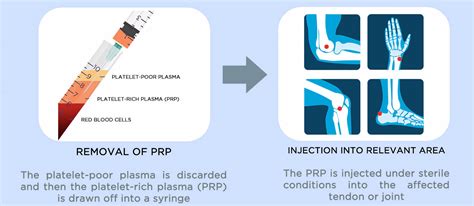 PRP Injections | Available at The Tendon Pain Clinic