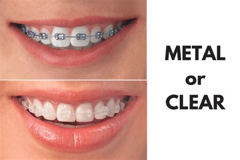 Clear Braces Vs. Metal Braces - Which One Is Right For You - DemotiX