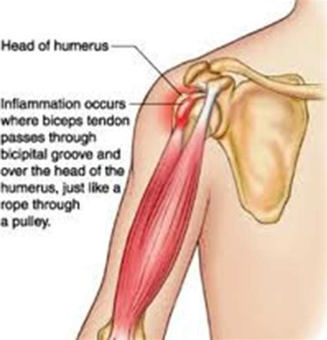 Diagram Of Shoulder Joint With Muscles Ligaments And Tendons - Blogger Lagi