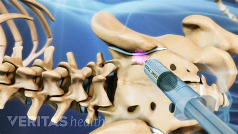 Spinal Injections For Back Pain