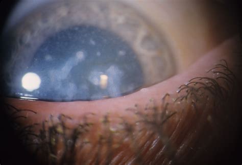 Corneal Dystrophy, Macular | Hereditary Ocular Diseases