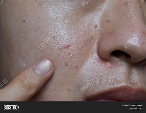 Acne Vulgaris Scars On Image & Photo (Free Trial) | Bigstock