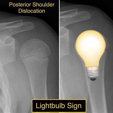 Anterior Shoulder Dislocation Radiology