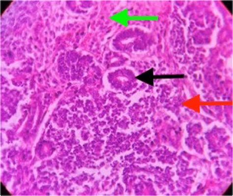 Photomicrograph (100x, H&E) showing histological features of a ...