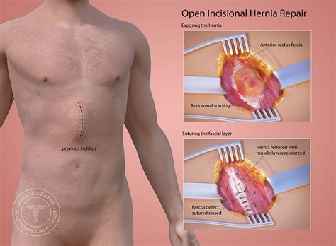 10 Best Clinics for Incisional Hernia Repair in Hungary [2023 Prices]